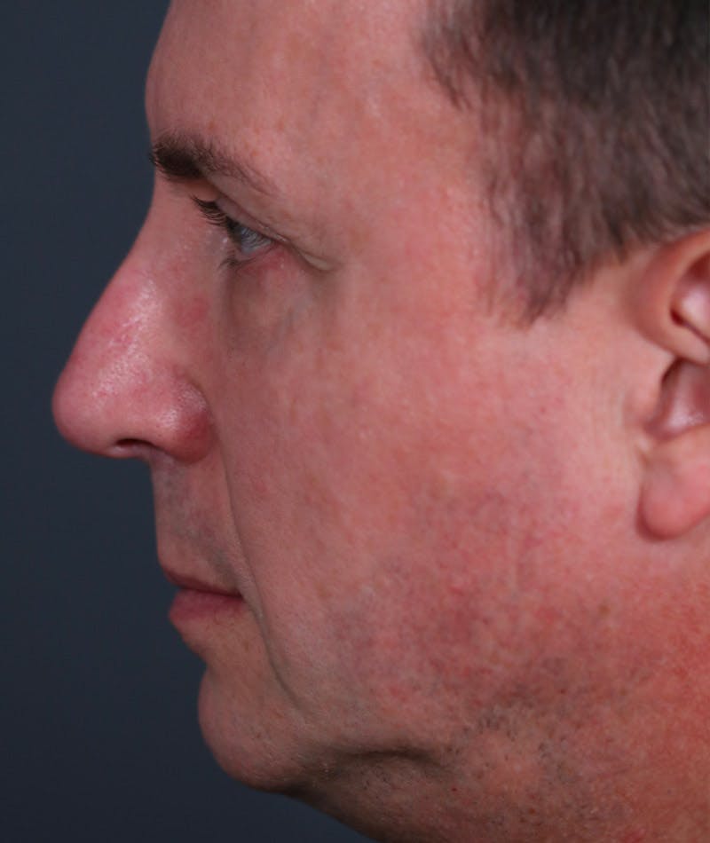 Revision Rhinoplasty Before & After Gallery - Patient 108191533 - Image 2