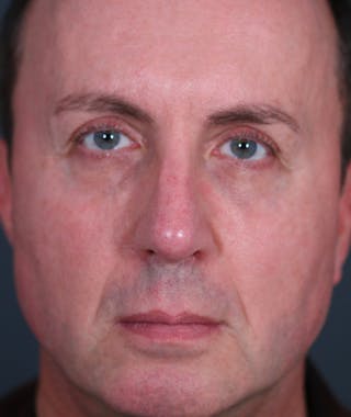 Revision Rhinoplasty Before & After Gallery - Patient 108191533 - Image 4