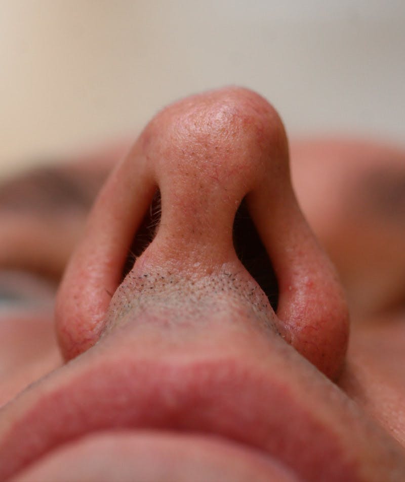 Revision Rhinoplasty Before & After Gallery - Patient 108191533 - Image 5