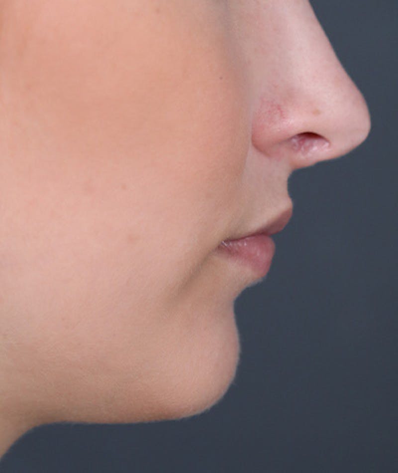 Revision Rhinoplasty Before & After Gallery - Patient 108191538 - Image 1