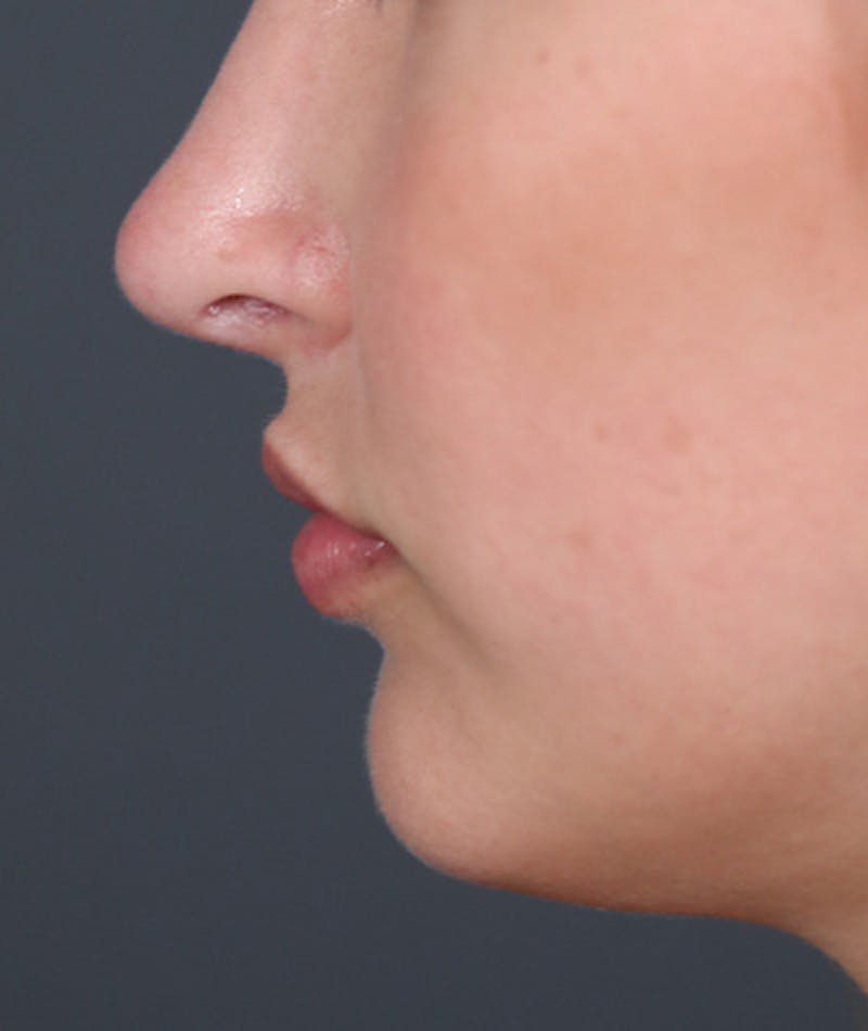 Revision Rhinoplasty Before & After Gallery - Patient 108191538 - Image 2