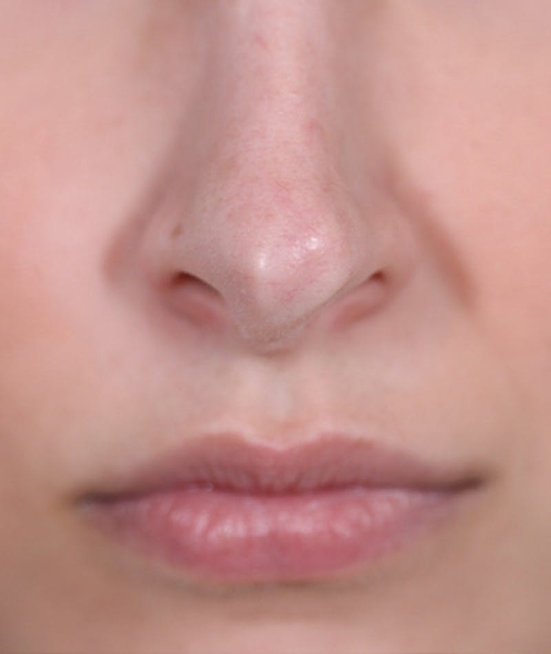 Revision Rhinoplasty Before & After Gallery - Patient 108191538 - Image 3