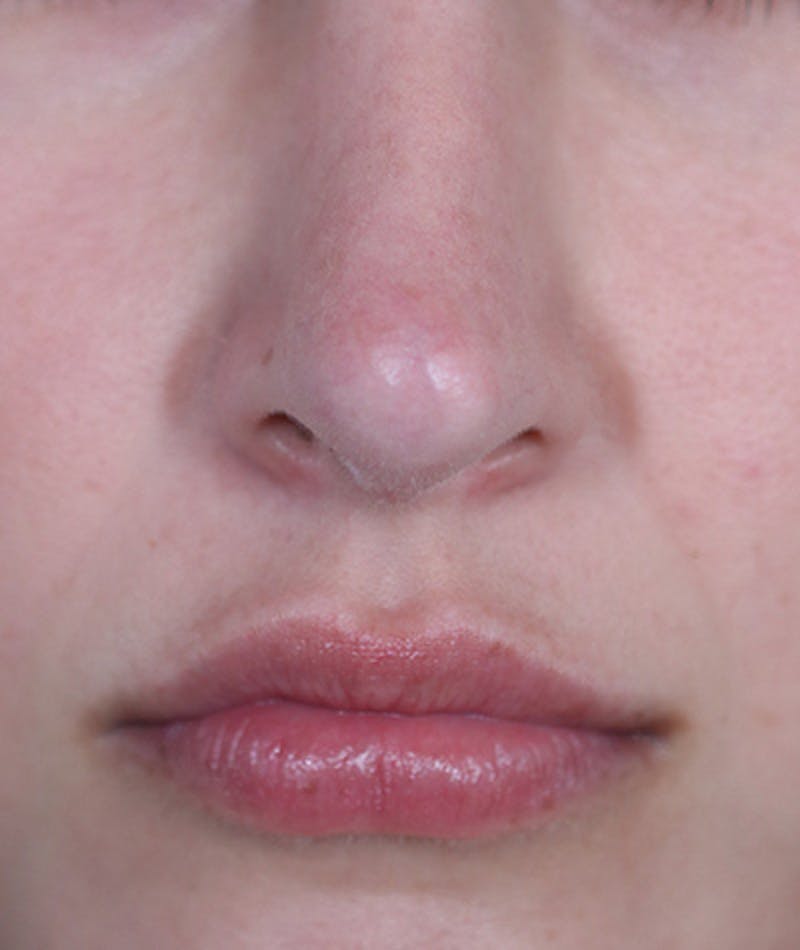 Revision Rhinoplasty Gallery - Patient 108191538 - Image 4