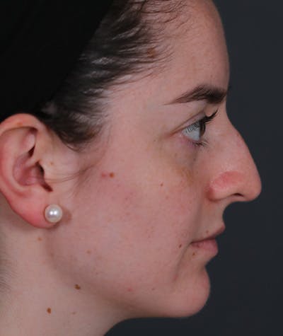 Revision Rhinoplasty Before & After Gallery - Patient 108191553 - Image 1