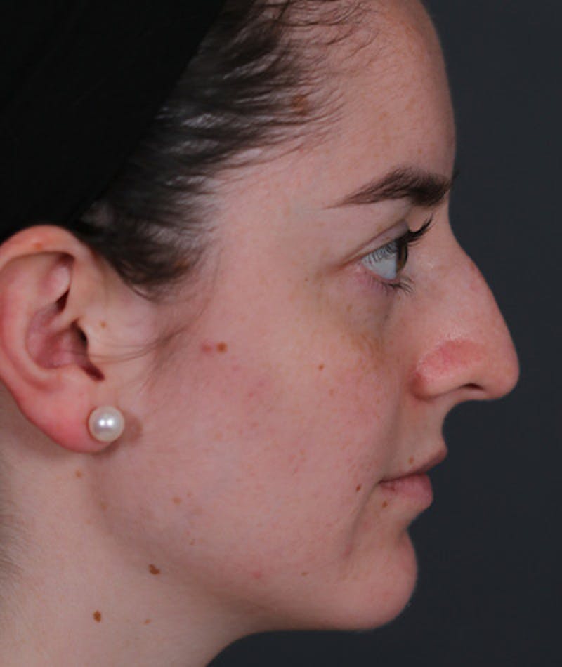 Revision Rhinoplasty Before & After Gallery - Patient 108191553 - Image 1