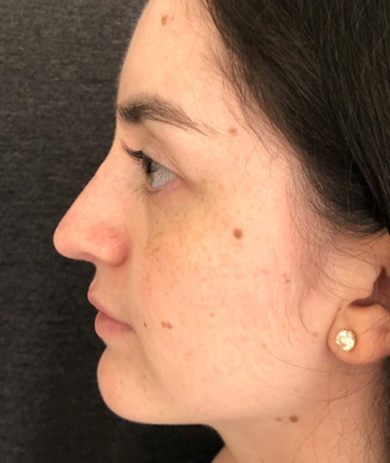 Revision Rhinoplasty Before & After Gallery - Patient 108191553 - Image 2