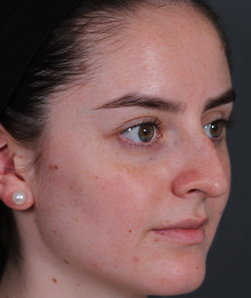 Revision Rhinoplasty Gallery - Patient 108191553 - Image 3