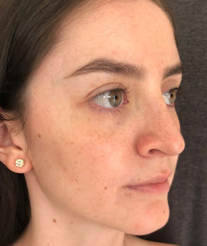 Revision Rhinoplasty Before & After Gallery - Patient 108191553 - Image 4