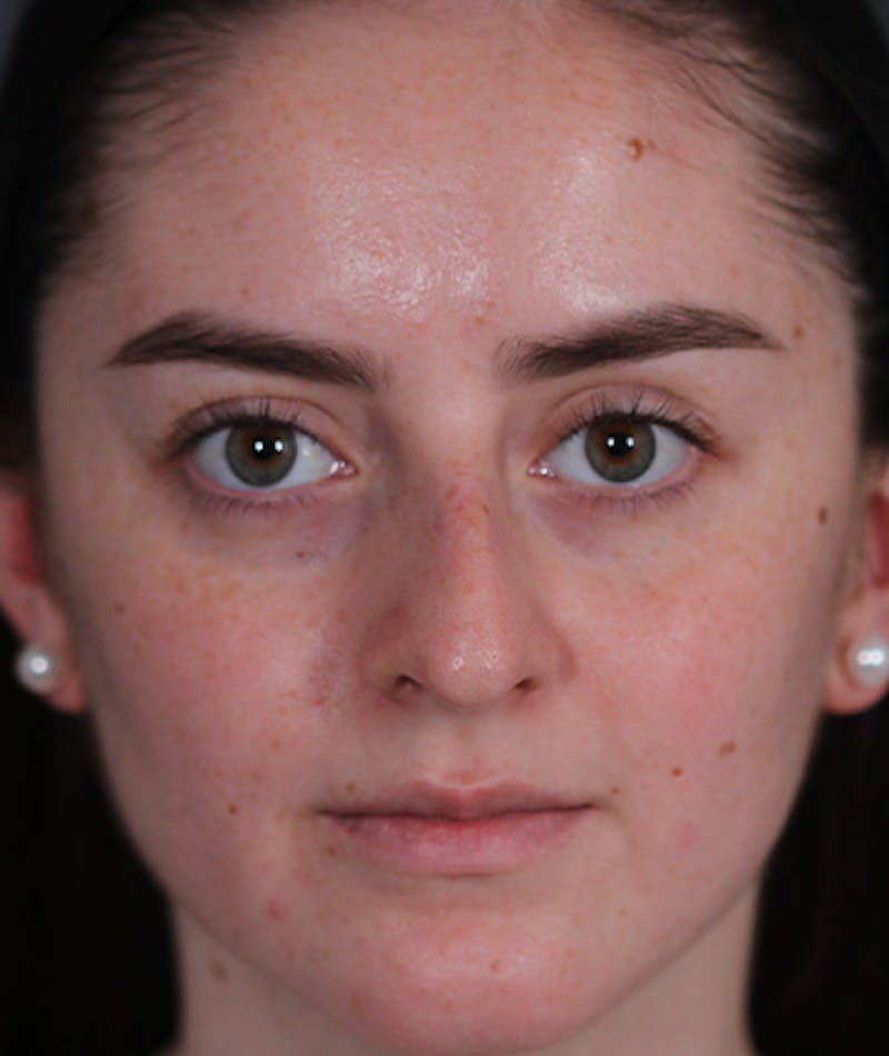 Revision Rhinoplasty Before & After Gallery - Patient 108191553 - Image 5