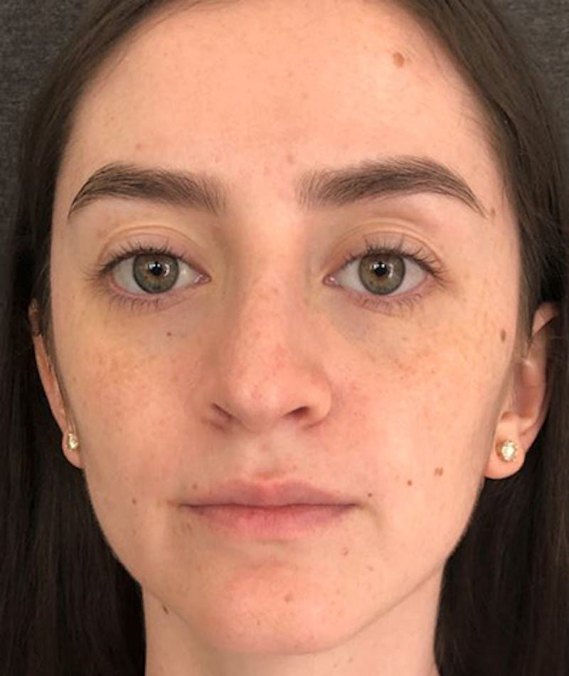 Revision Rhinoplasty Before & After Gallery - Patient 108191553 - Image 6