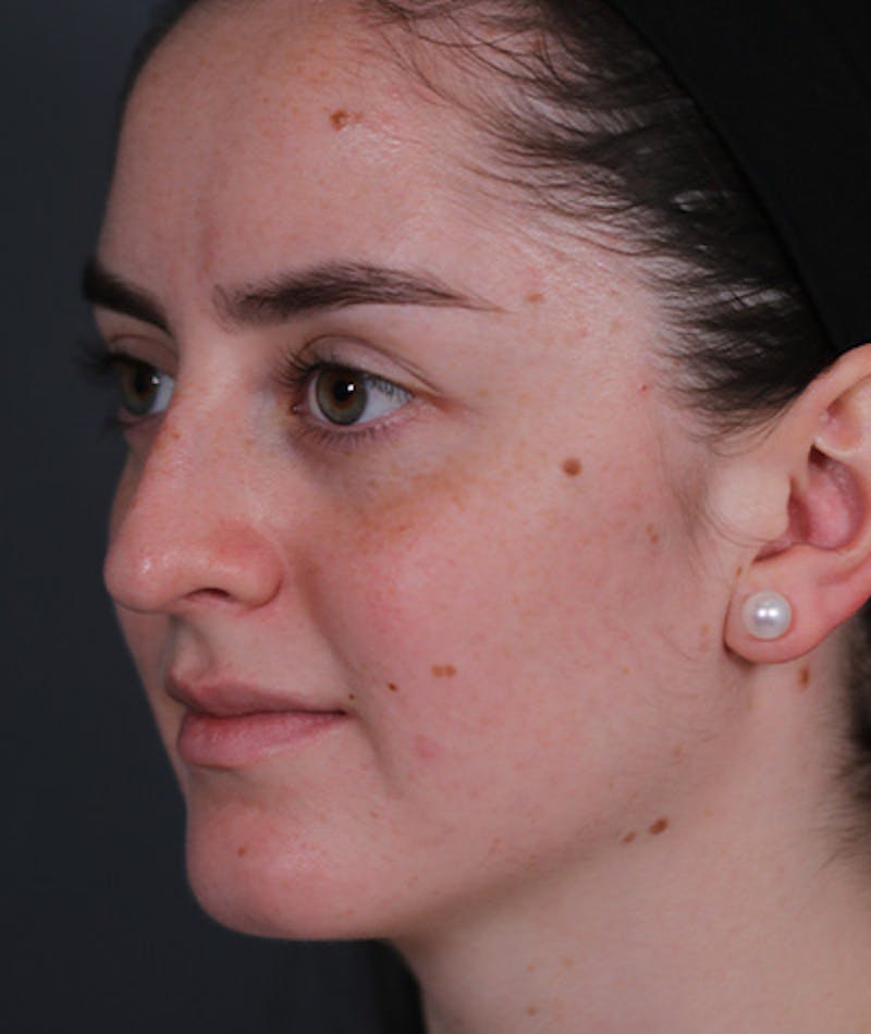 Revision Rhinoplasty Before & After Gallery - Patient 108191553 - Image 7