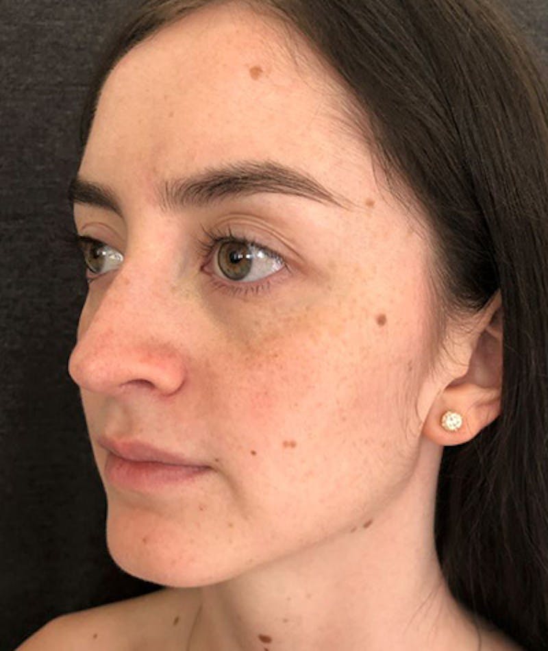 Revision Rhinoplasty Before & After Gallery - Patient 108191553 - Image 8