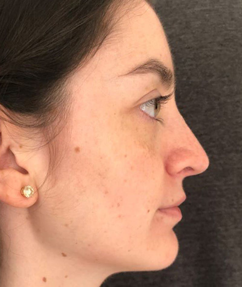 Revision Rhinoplasty Before & After Gallery - Patient 108191553 - Image 9