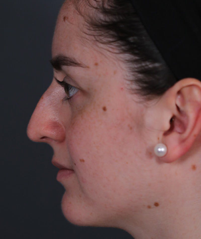 Revision Rhinoplasty Before & After Gallery - Patient 108191553 - Image 10