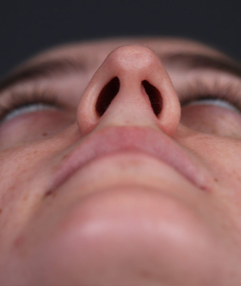 Revision Rhinoplasty Before & After Gallery - Patient 108191553 - Image 11