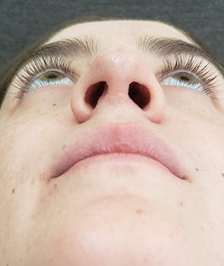 Revision Rhinoplasty Before & After Gallery - Patient 108191553 - Image 12