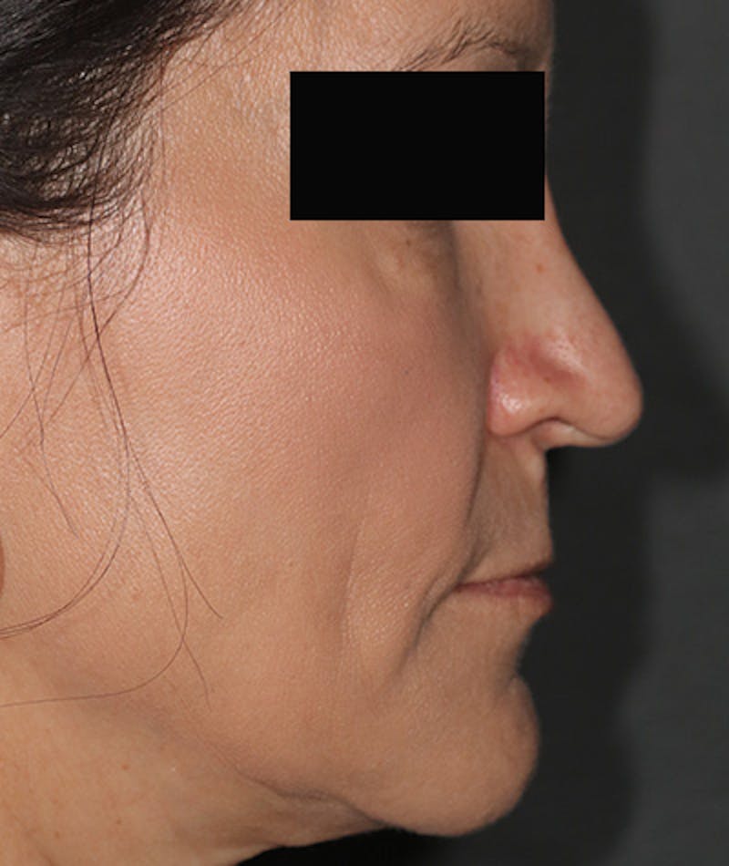 Revision Rhinoplasty Before & After Gallery - Patient 108191556 - Image 1