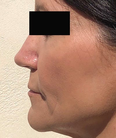 Revision Rhinoplasty Before & After Gallery - Patient 108191556 - Image 2