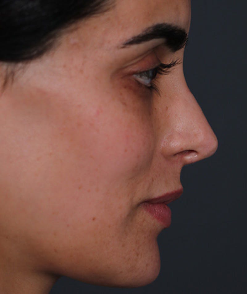 Revision Rhinoplasty Before & After Gallery - Patient 108191562 - Image 1