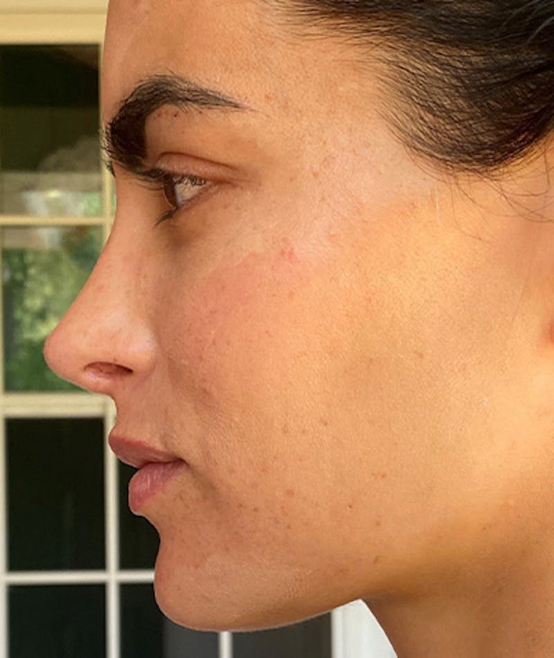 Revision Rhinoplasty Before & After Gallery - Patient 108191562 - Image 2