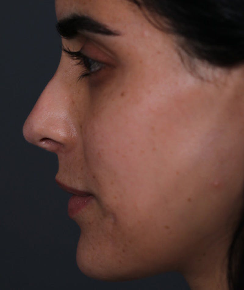 Revision Rhinoplasty Before & After Gallery - Patient 108191562 - Image 3