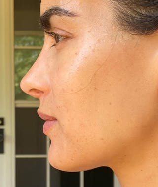 Revision Rhinoplasty Before & After Gallery - Patient 108191562 - Image 4