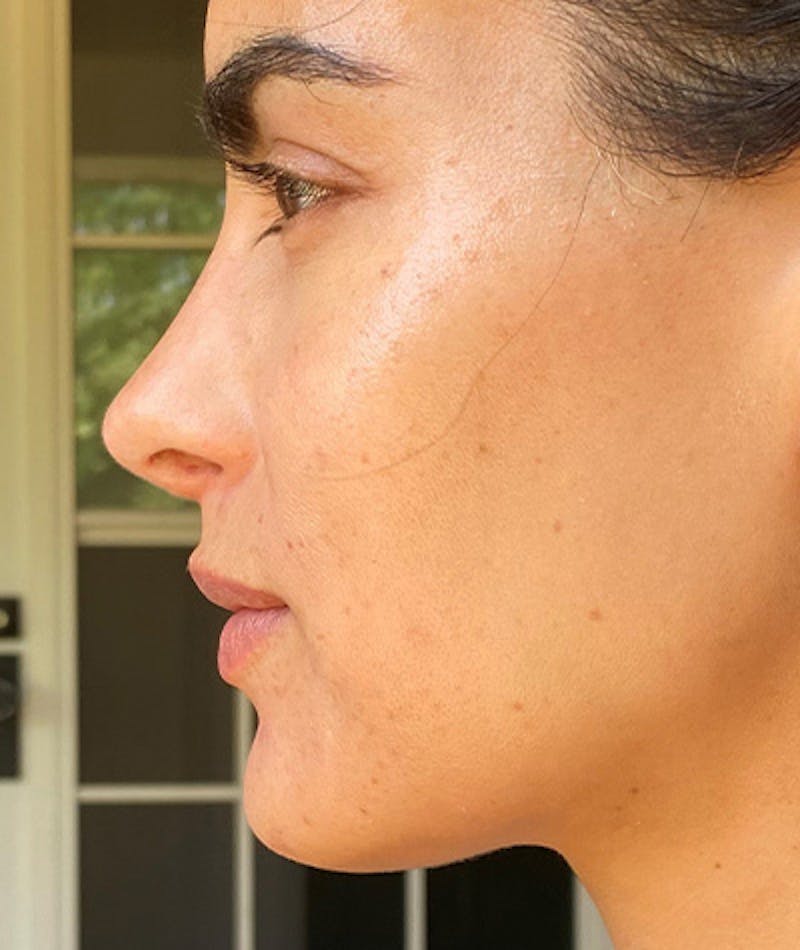 Revision Rhinoplasty Before & After Gallery - Patient 108191562 - Image 4