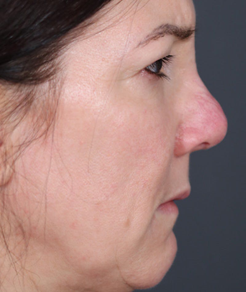 Revision Rhinoplasty Before & After Gallery - Patient 108191572 - Image 1