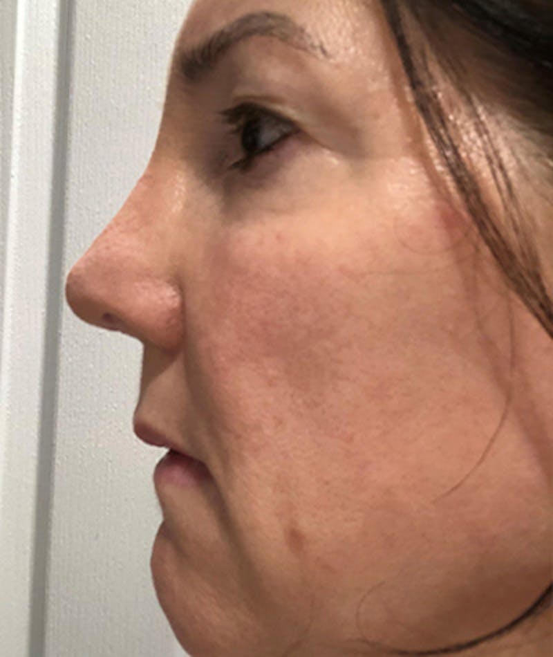 Revision Rhinoplasty Before & After Gallery - Patient 108191572 - Image 2