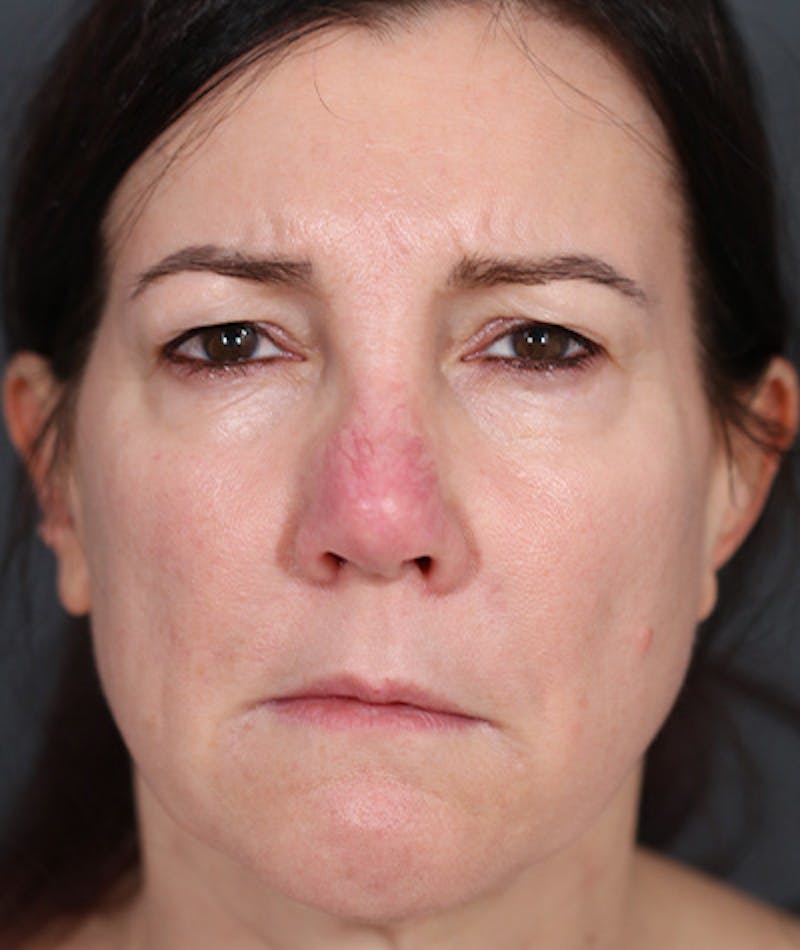 Revision Rhinoplasty Before & After Gallery - Patient 108191572 - Image 3