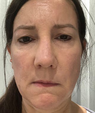 Revision Rhinoplasty Before & After Gallery - Patient 108191572 - Image 4