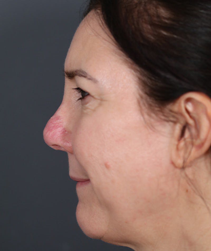 Revision Rhinoplasty Before & After Gallery - Patient 108191572 - Image 5