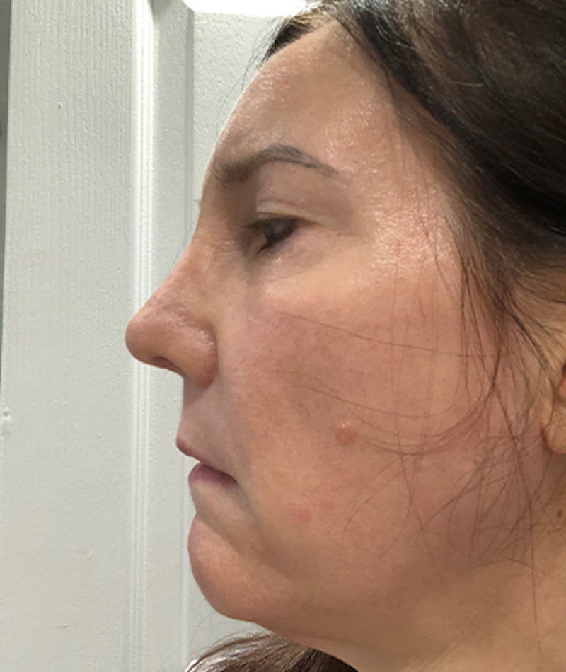 Revision Rhinoplasty Before & After Gallery - Patient 108191572 - Image 6