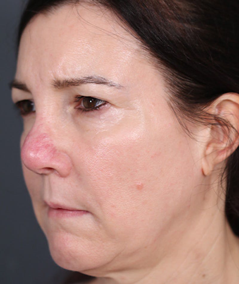 Revision Rhinoplasty Before & After Gallery - Patient 108191572 - Image 7