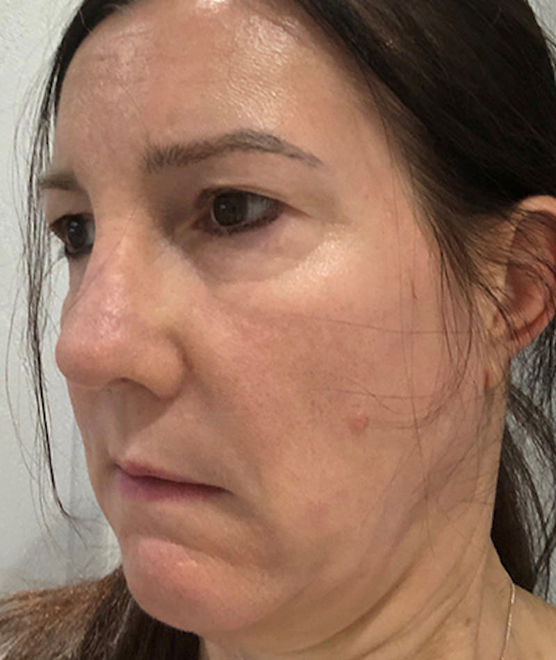 Revision Rhinoplasty Before & After Gallery - Patient 108191572 - Image 8