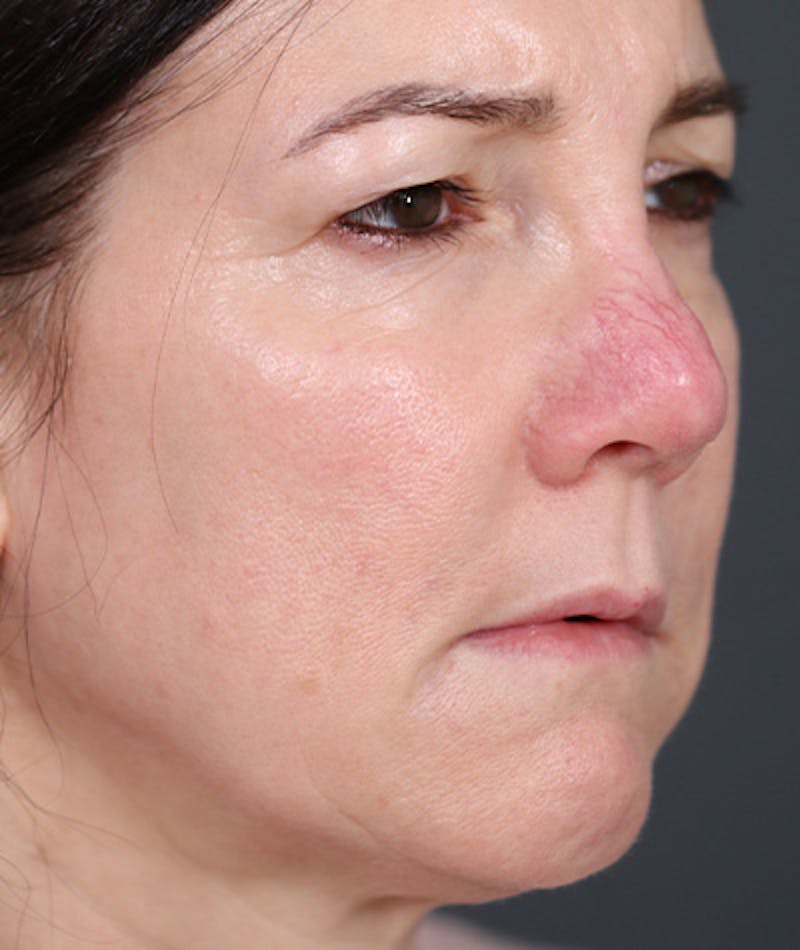 Revision Rhinoplasty Before & After Gallery - Patient 108191572 - Image 9