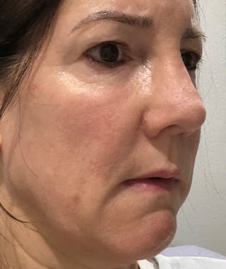 Revision Rhinoplasty Before & After Gallery - Patient 108191572 - Image 10