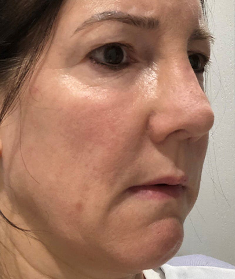 Revision Rhinoplasty Gallery - Patient 108191572 - Image 10