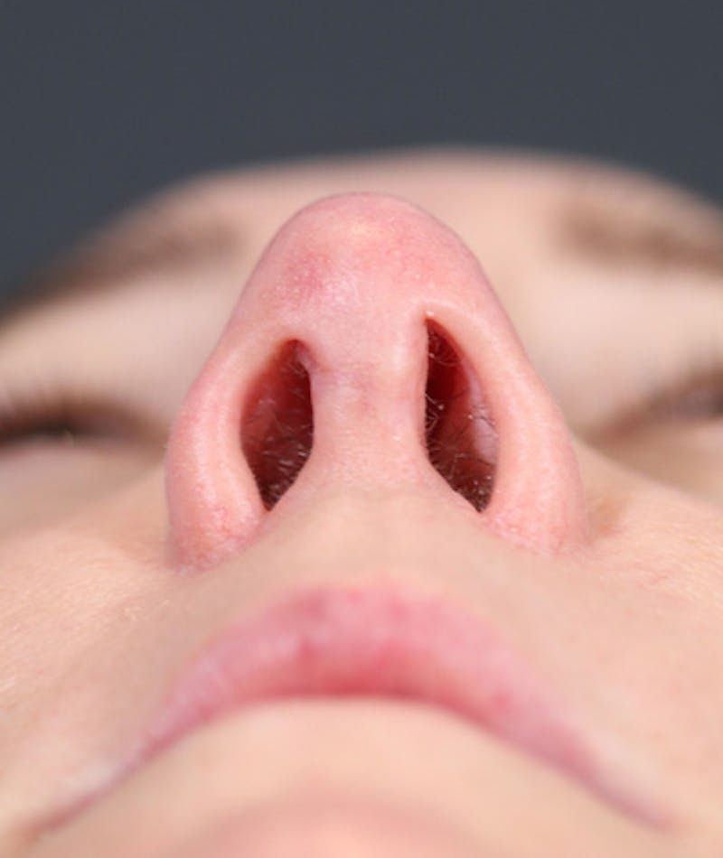 Revision Rhinoplasty Before & After Gallery - Patient 108191572 - Image 11