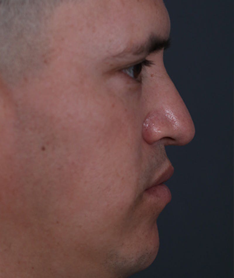 Revision Rhinoplasty Before & After Gallery - Patient 108191577 - Image 1