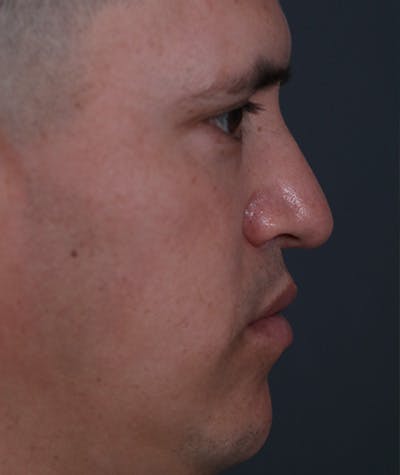 Revision Rhinoplasty Before & After Gallery - Patient 108191577 - Image 1