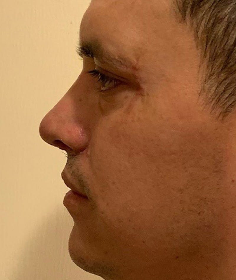 Revision Rhinoplasty Before & After Gallery - Patient 108191577 - Image 2