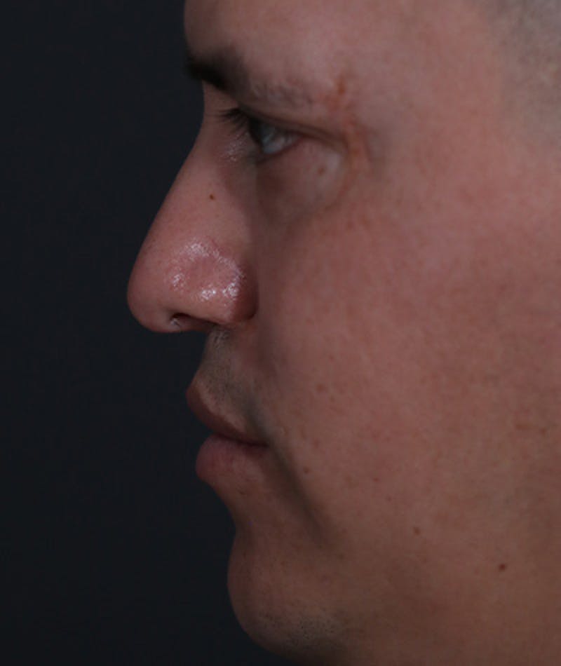 Revision Rhinoplasty Before & After Gallery - Patient 108191577 - Image 3