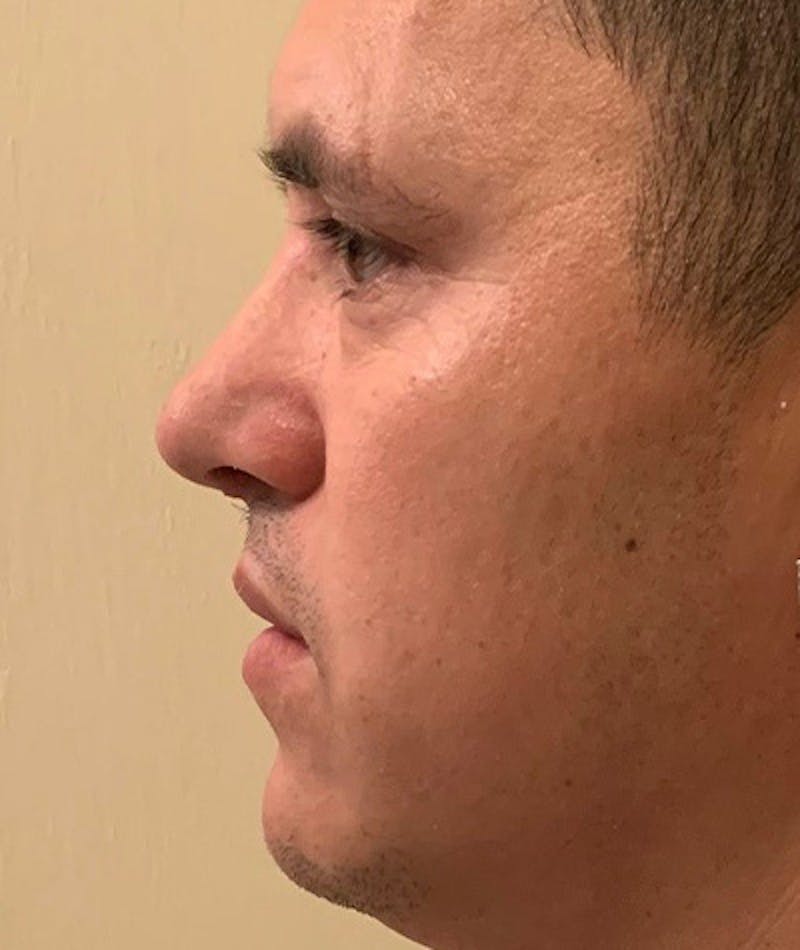 Revision Rhinoplasty Before & After Gallery - Patient 108191577 - Image 4