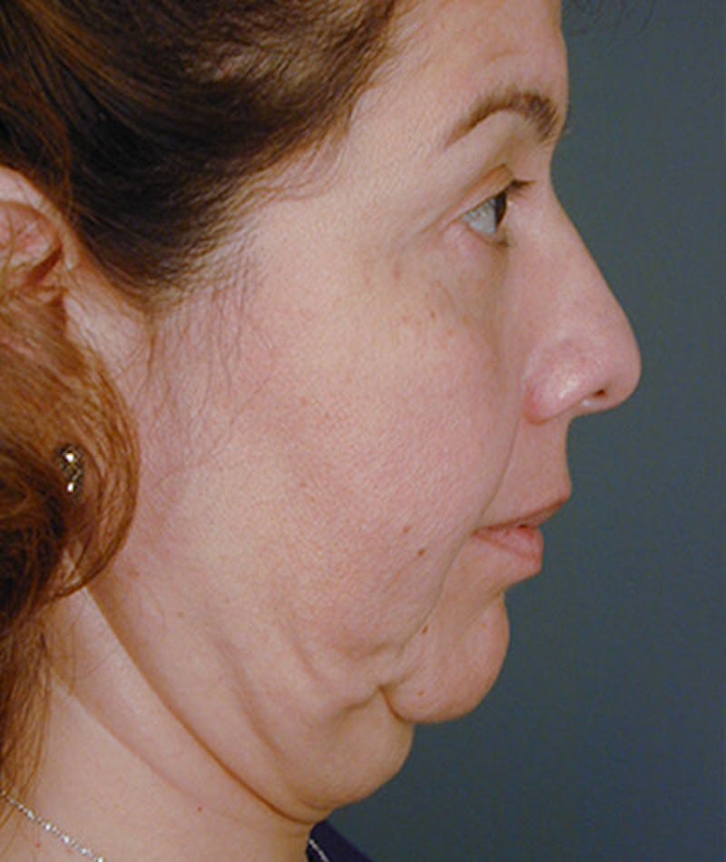 Facelift Before & After Gallery - Patient 108403866 - Image 1