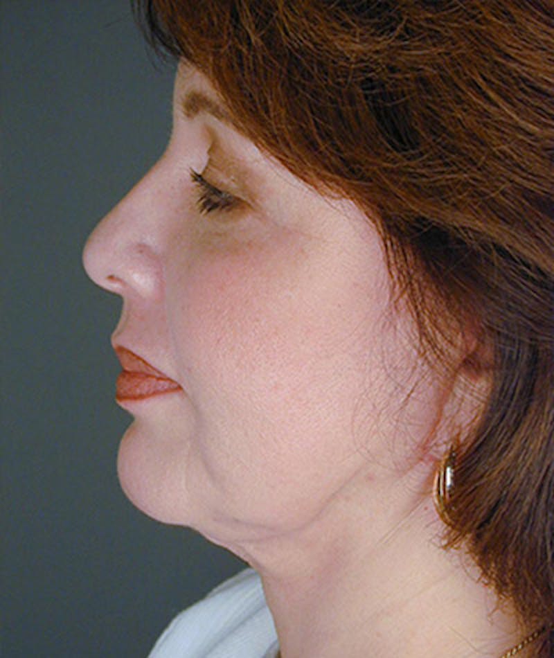 Facelift Before & After Gallery - Patient 108403866 - Image 4