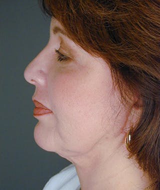 Facelift Before & After Gallery - Patient 108403866 - Image 4