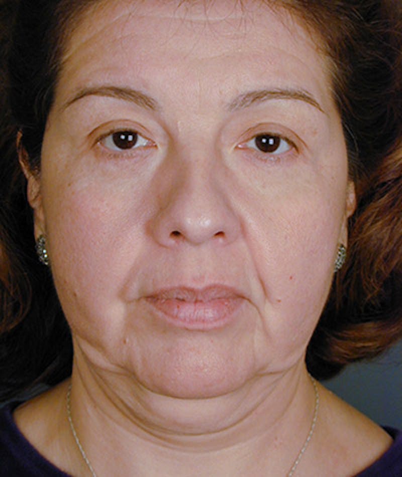 Facelift Before & After Gallery - Patient 108403866 - Image 5