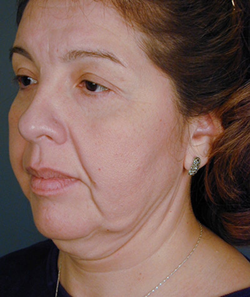Facelift Before & After Gallery - Patient 108403866 - Image 1