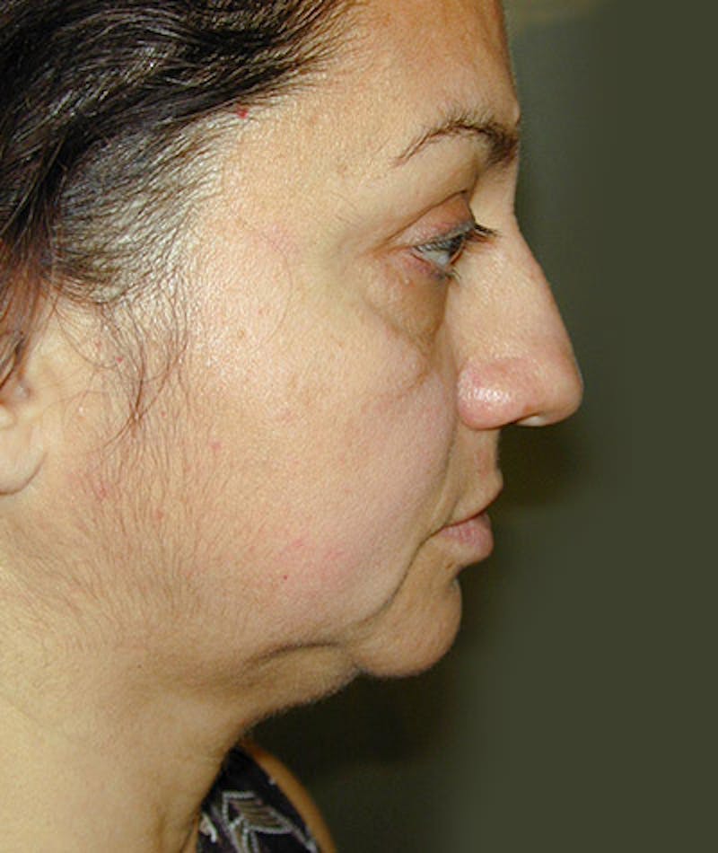 Facelift Before & After Gallery - Patient 108403891 - Image 3